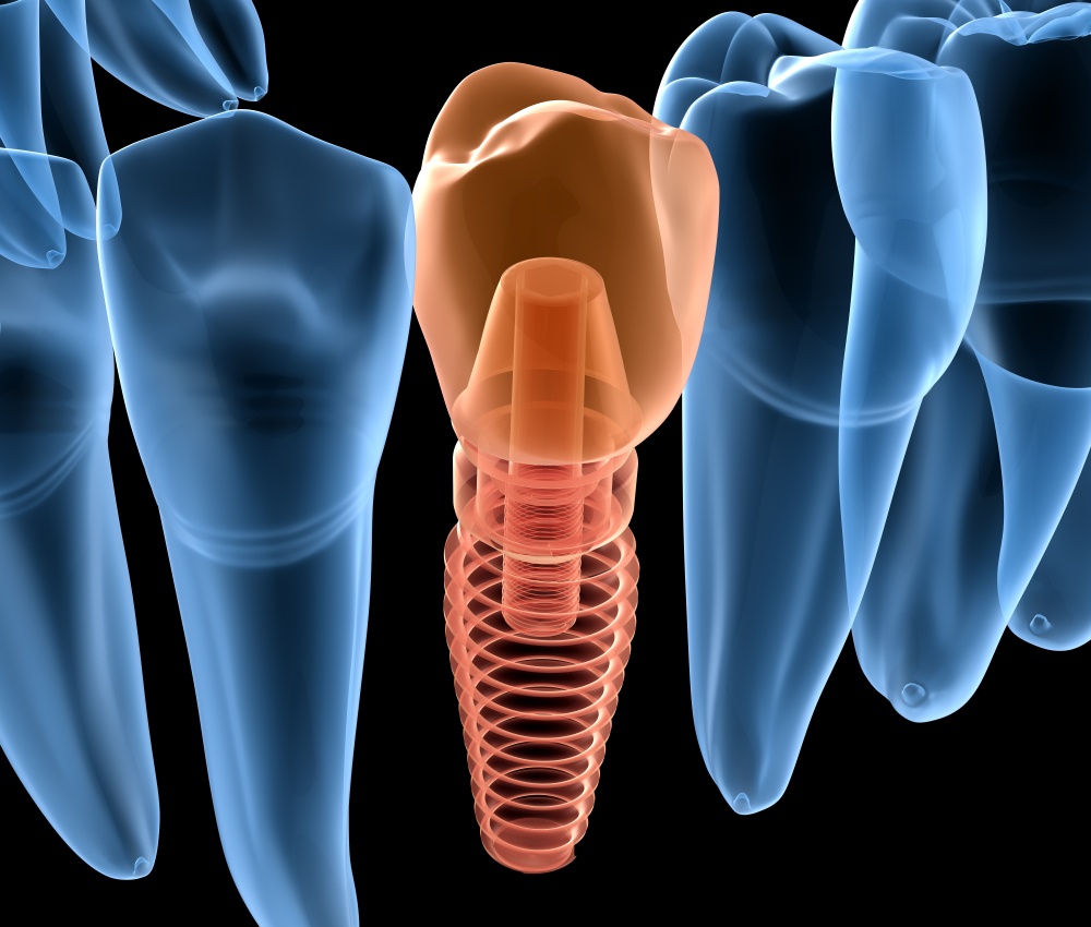 Read more about the article Dental Implant Information
