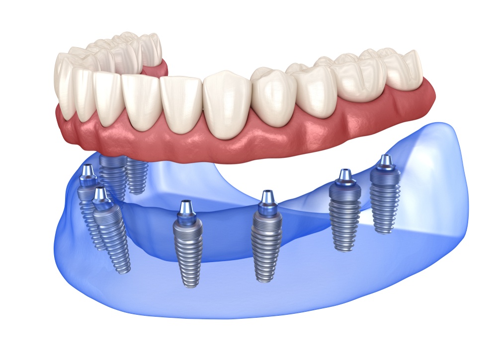 Read more about the article Implant Retained Dentures