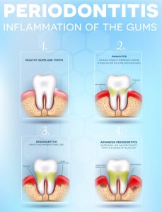 Stages Periodontal disease  - Baton Rouge Design, Zobrist Dental